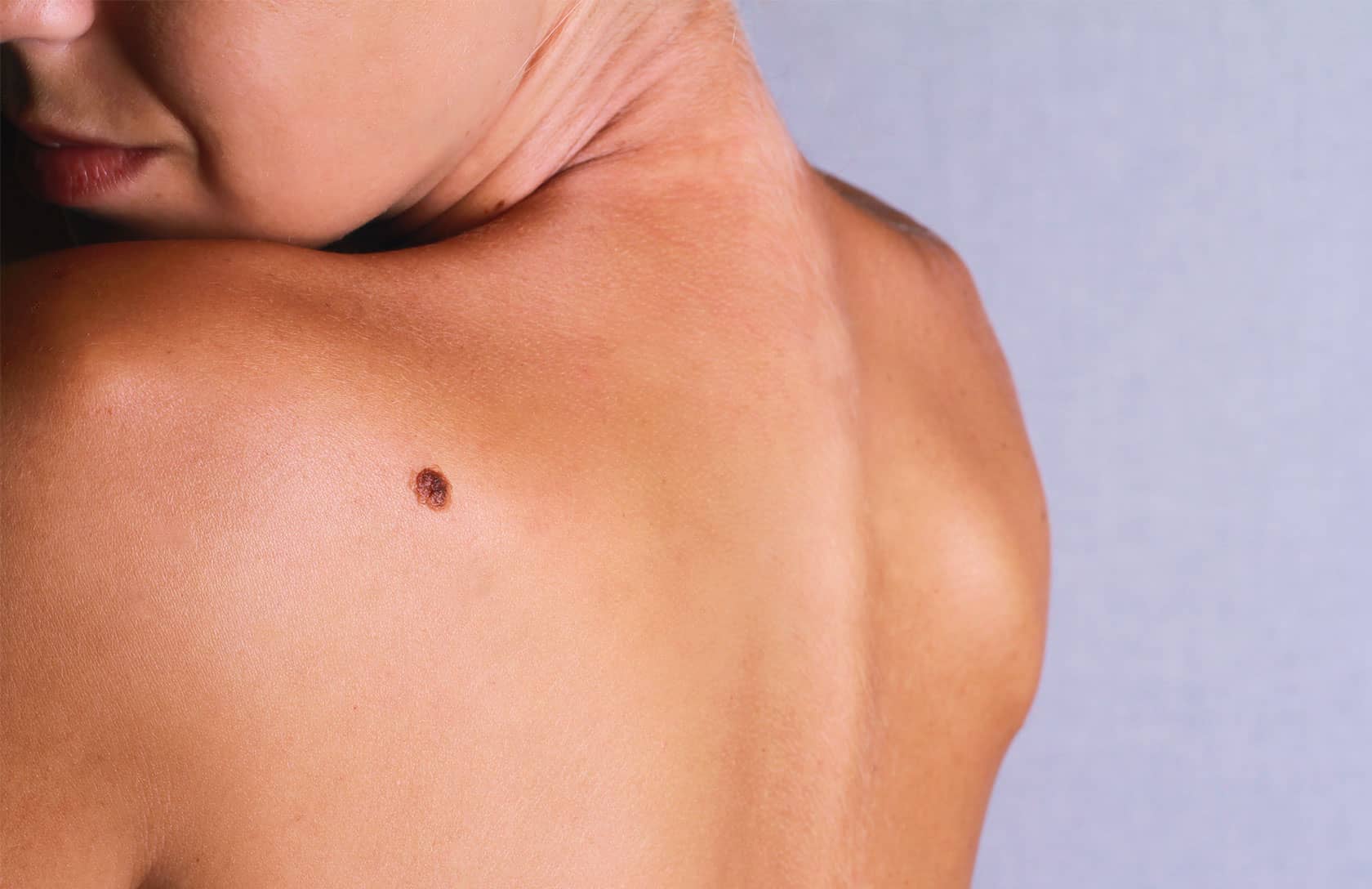 Chirurgie dermatologique 2