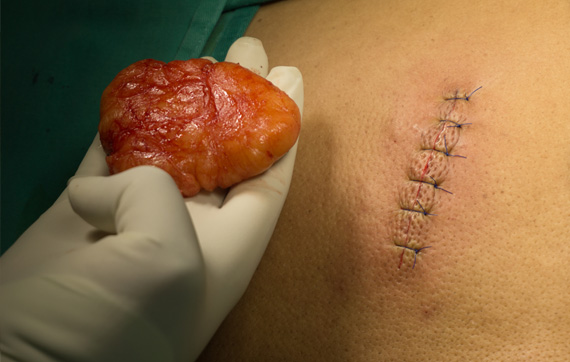 Chirurgie dermatologique 3